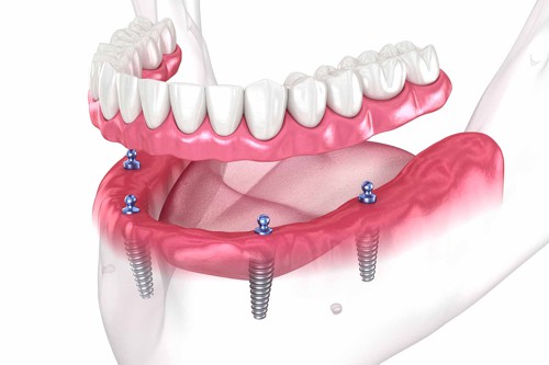 kdy jsou zubní implantáty vhodné: 4. Celková snímatelná náhrada nesená implantáty