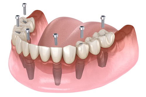 Kdy jsou zubní implantáty vhodné - 3. Náhrada mnoha chybějících zubů